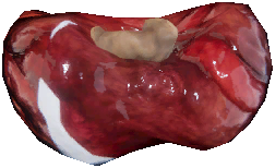 变异甲状腺腺体
